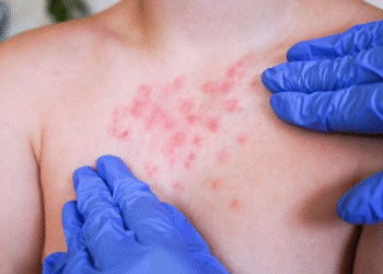 Salud reporta en Puebla 92 casos confirmados de sarampión y 297 probables