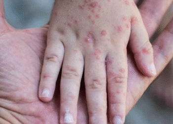 Salud reporta 44 casos de sarampión: grupo de riesgo está en adultos de 20 a 45 años