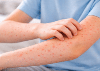 Incrementa de 159 a 174 casos probables de sarampión en Puebla: 45 confirmados